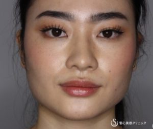 ボトックス_おすすめ_東京