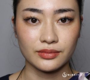 ボトックス_おすすめ_東京