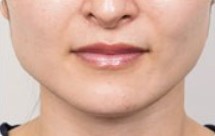 ボトックス_おすすめ_東京