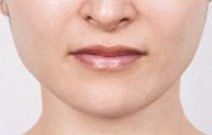 ボトックス_おすすめ_東京