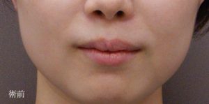 ボトックス_おすすめ_東京