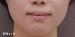 ボトックス_おすすめ_東京