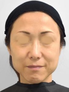 ボトックス_おすすめ_東京