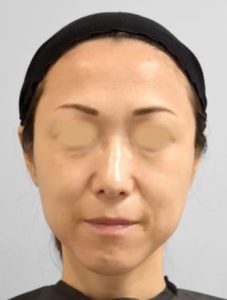 ボトックス_おすすめ_東京