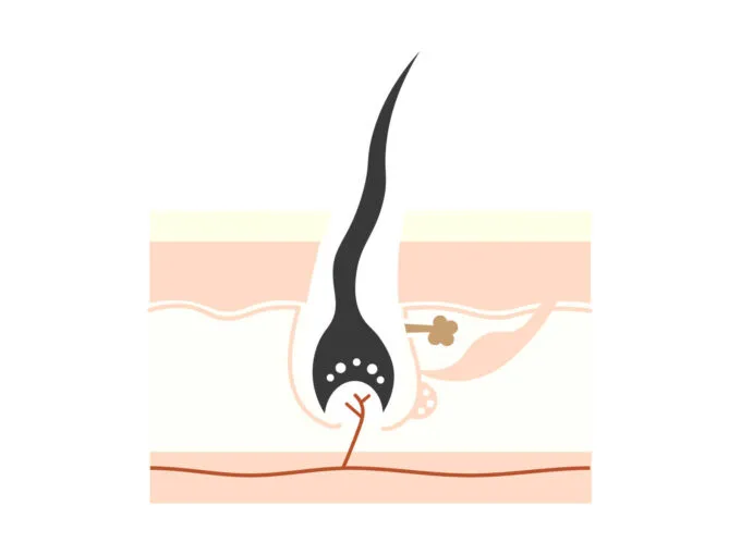 AGA_毛が細くなる