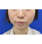 ボトックス 東京