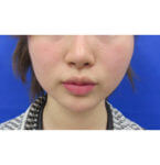 ボトックス 東京