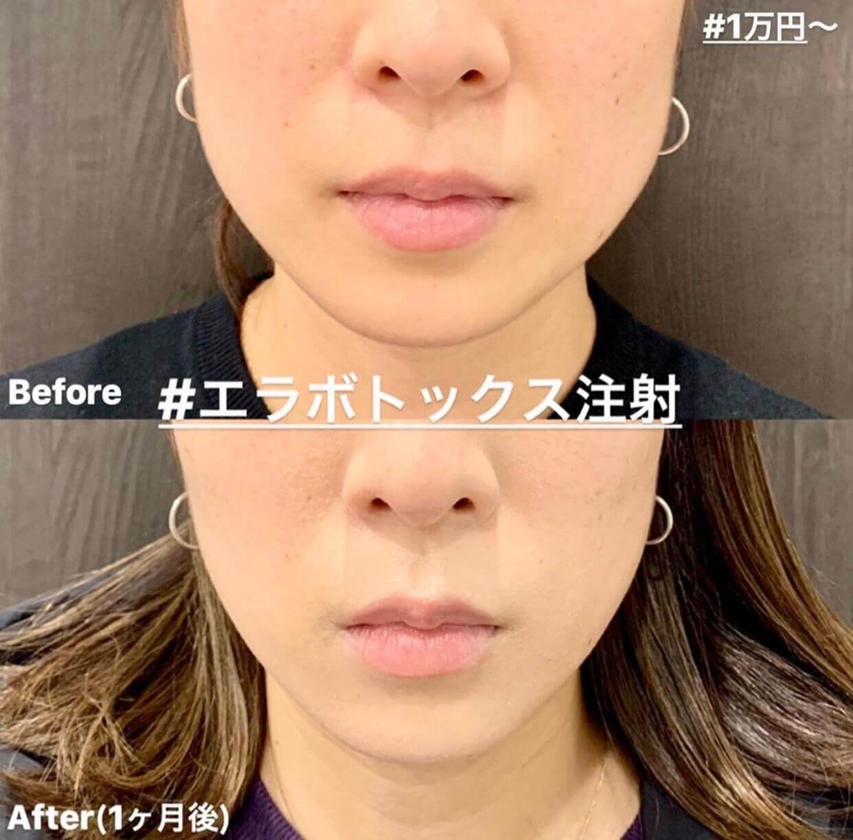 ボトックス 東京