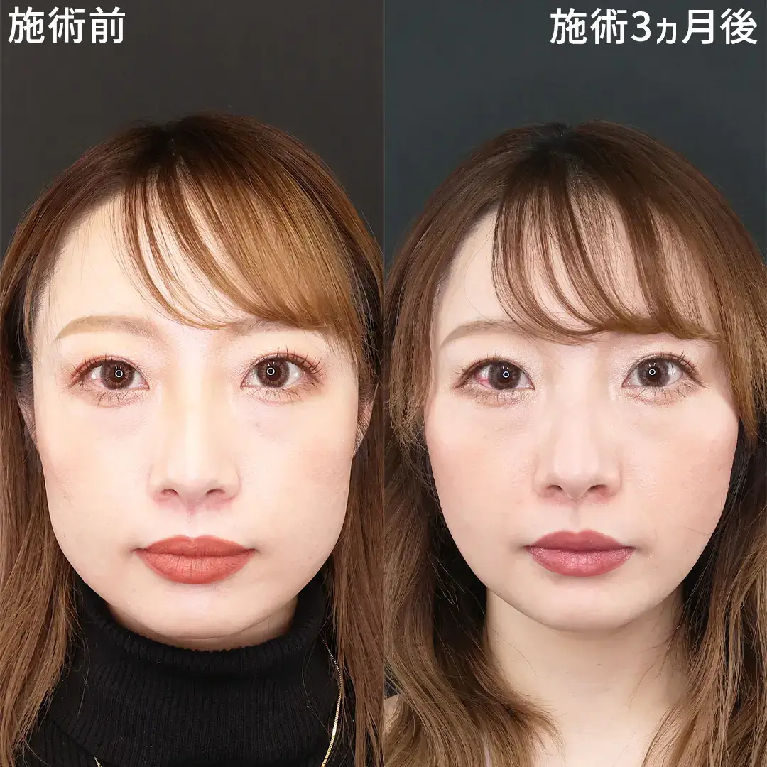 ボトックス 東京