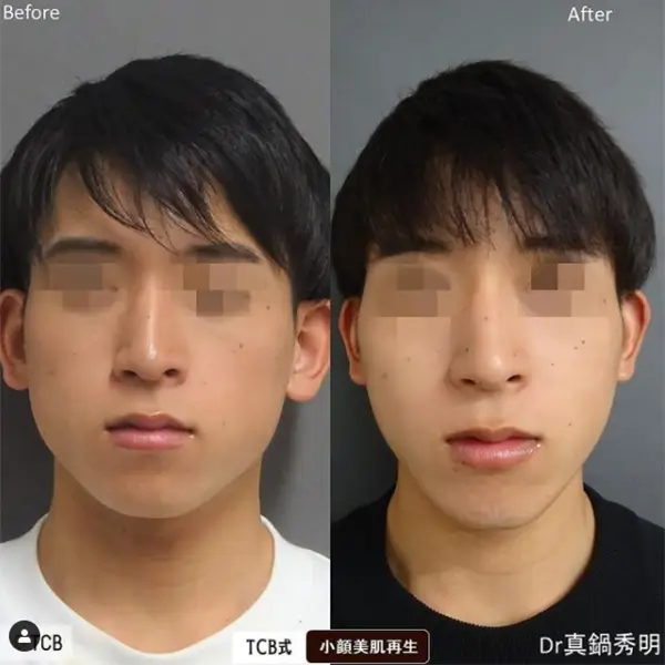 ボトックス 東京