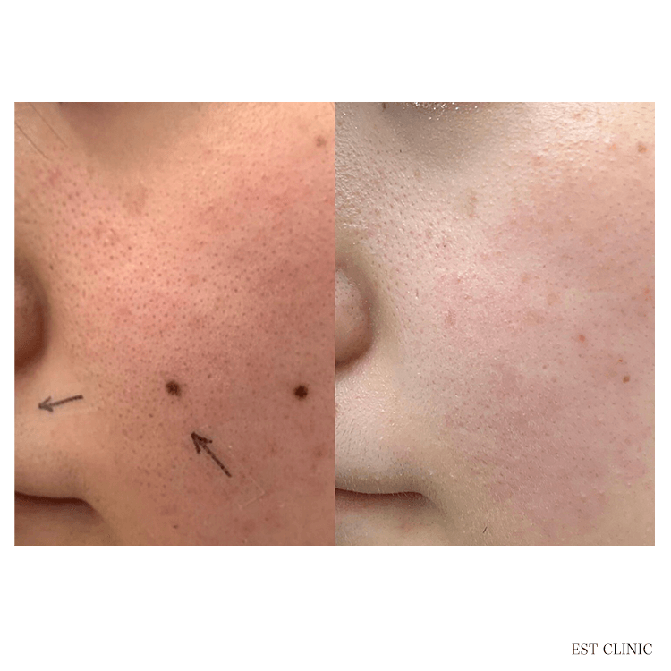 ほくろ除去_ 評判のいい病院_エストクリニック