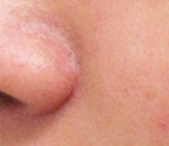 ほくろ除去_ 評判のいい病院_品川スキンクリニック美容皮フ科