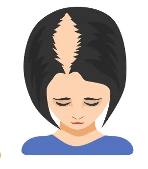 びまん性脱毛症_イメージ