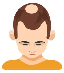 円形脱毛症_イメージ