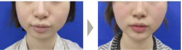 エラボトックス症例写真